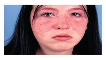 蝶形红斑是见于系统性红斑狼疮患者两侧面颊对称性的面部红斑