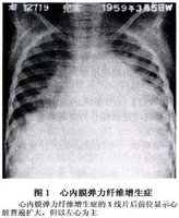 心内膜弹力纤维增生症