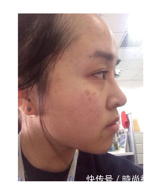 白醋配它祛斑真的管用?如果不这样,斑点竟然会