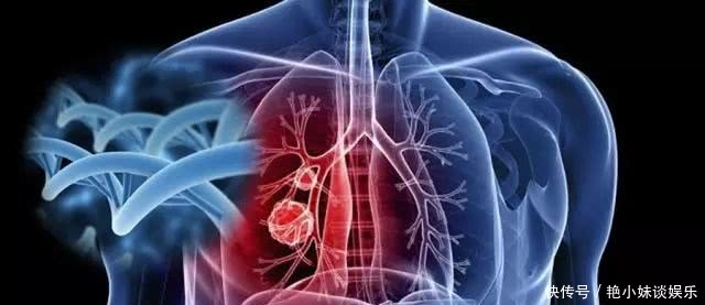 肺癌初期的症状有哪些?早期发现很重要!