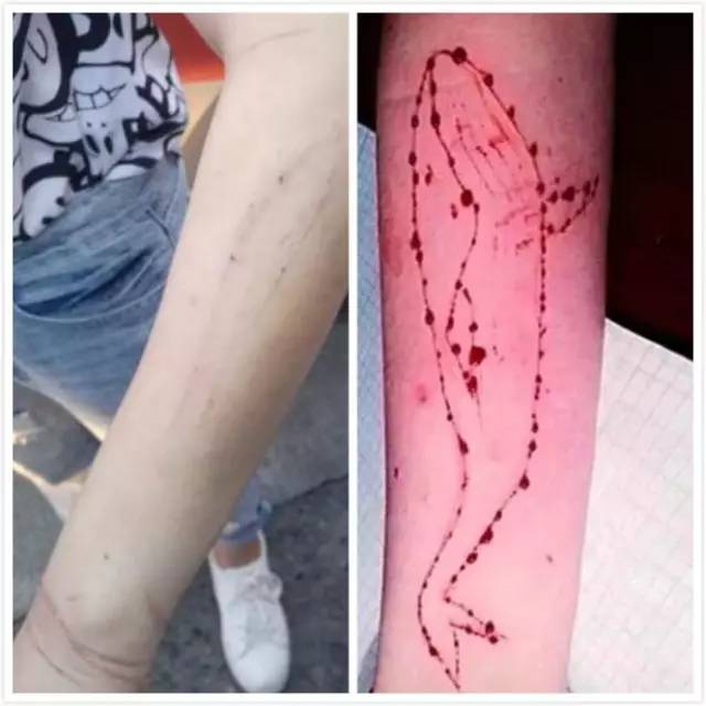 (左为女孩手臂,右为蓝鲸图案) 女孩手臂累累伤痕! 竟是生父虐待所致?
