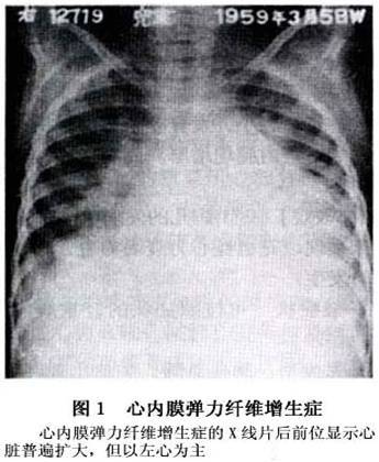 心内膜弹力纤维增生症