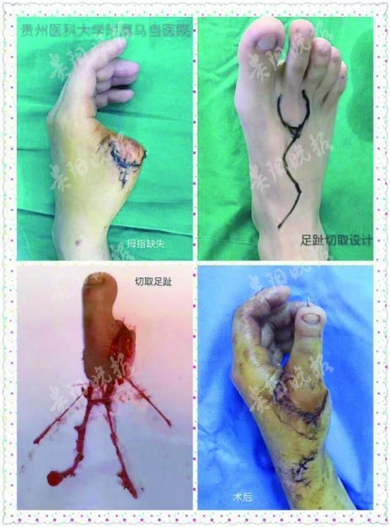 男子左手拇指被割断 医生"移花接木"脚趾变手指