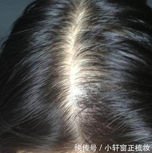 头发出现3大症状,头螨无疑,灭头螨方法简单1招