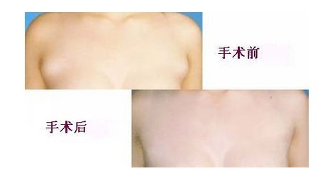 有治疗副乳的内衣吗(2)