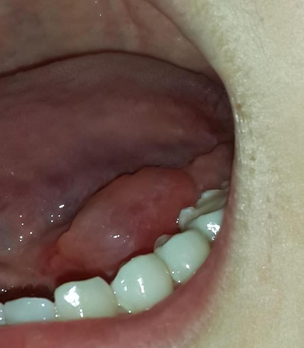 舌头下面起了一个大泡不知道是不是舌下囊肿.