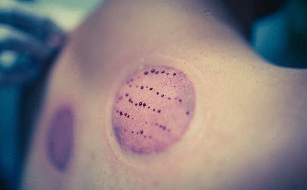 拔罐有好处吗? 身上出现水泡和紫红色的印记是