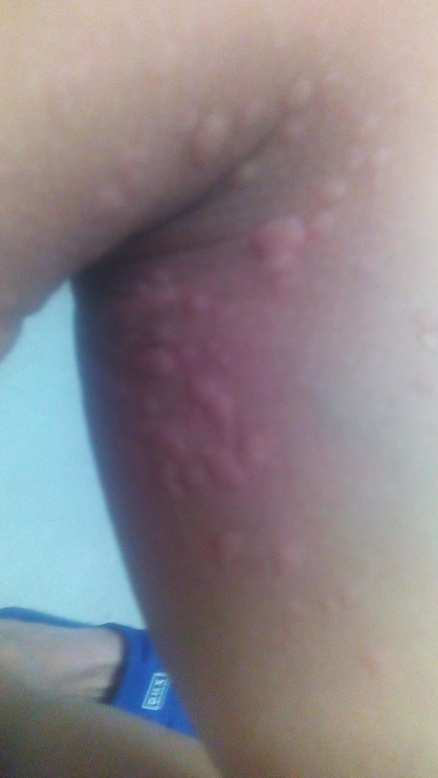 海鲜与过敏药_蛋白质海鲜过敏图片_海鲜过敏吃啥药(2)