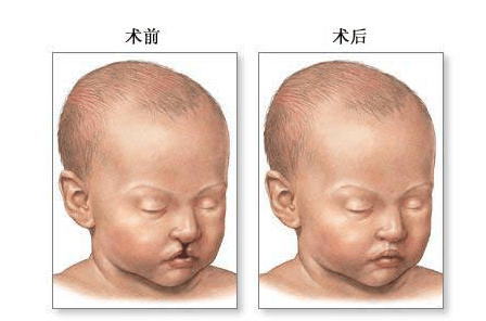 宝宝出生后唇腭裂被父母扔在医院,一年半后他们还有脸来接