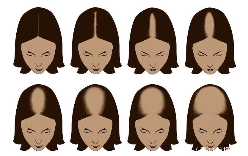 90后脱发严重,网友称90后活成了60后