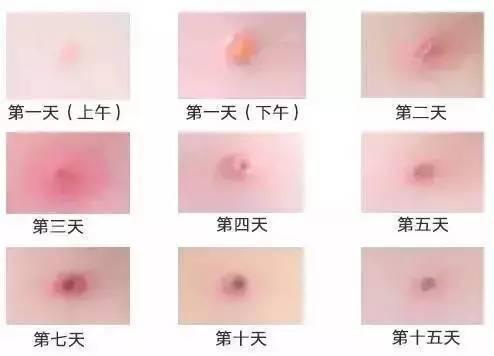 水痘和带状疱疹有啥不一样?
