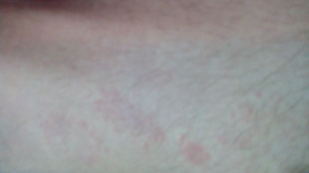 粉红色针尖型小疹子 大腿内侧 肩膀处 小片面积 不疼不痒