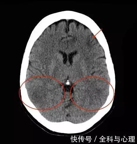 从 MRI 来识别 肝性脑病