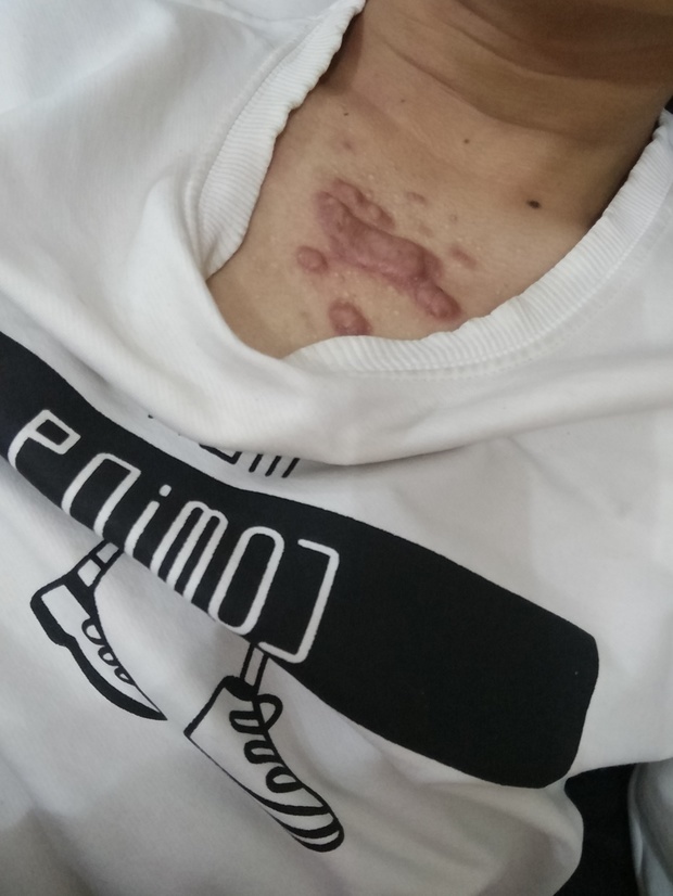 我胸口上的痘痘是怎么回事两年多了_360问答