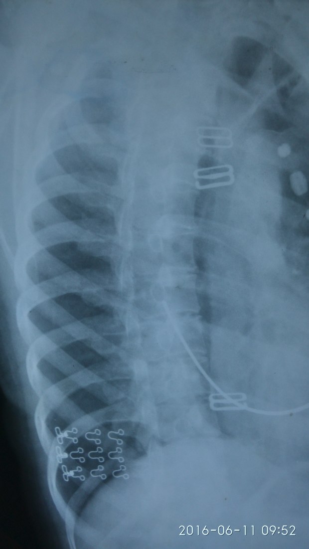 胸椎x线检查发现一个椎体上有二个空洞影是什么