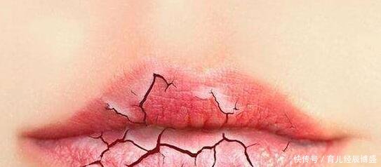 孕妇嘴唇干裂可以用润唇膏吗 孕妇用什么润唇