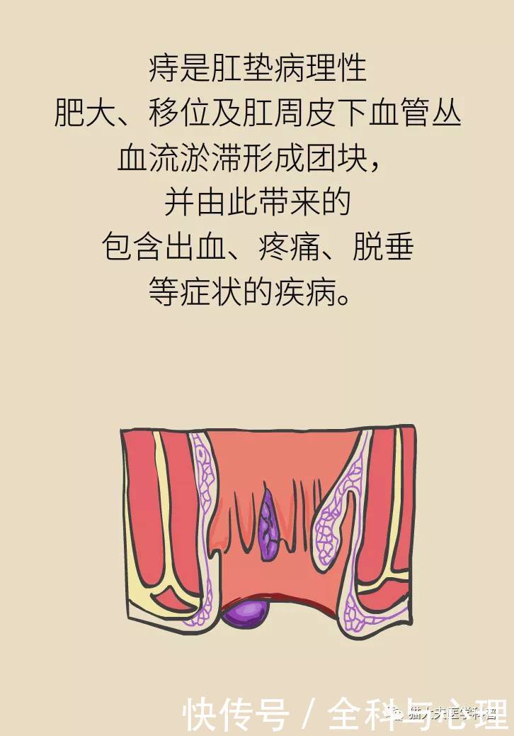 得了痔疮是一种什么样的体验?