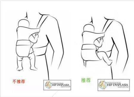 宝宝走路不稳、腿纹不对称, 家长要警惕是髋关