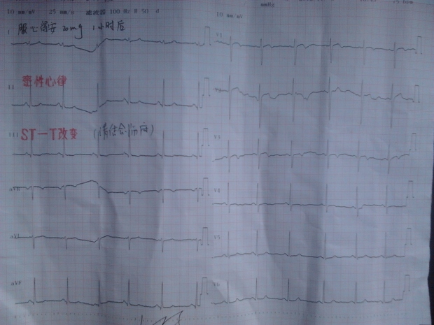 心得安对心电图st-t改变影响的临床意义