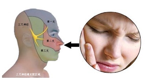 三叉神经痛与其他面部疼痛的区别!