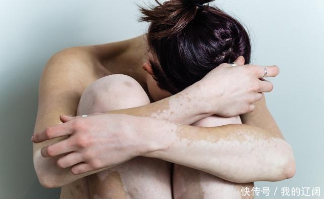 引起白癜风发生的真正诱因是什么
