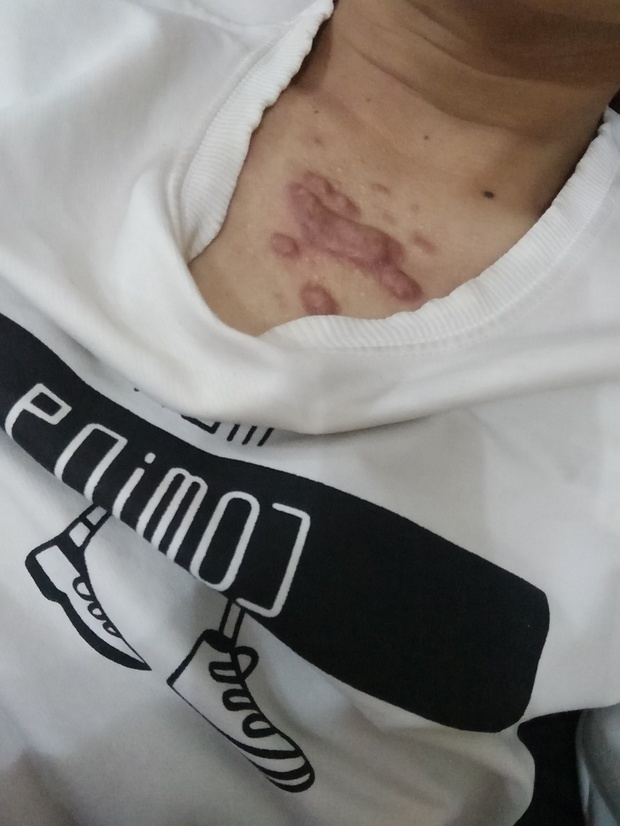 我胸口上的痘痘是怎么回事两年多了_360问答