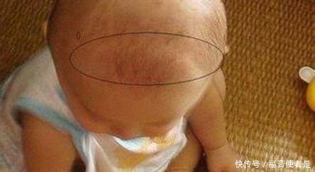 宝宝的头顶上有个坑出现了这4种状况,赶紧送