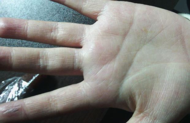   (5)若手掌不发黄,只是手指之间的分叉处变成黄色,表示体内