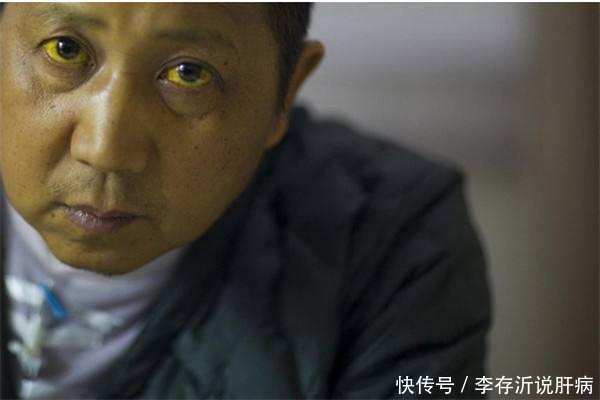 真是案例分享,如何知道自己是不是有酒精肝