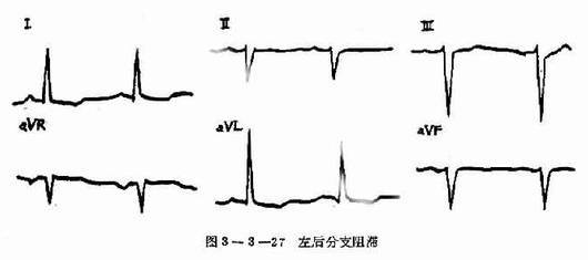 完全性左束支传导阻滞