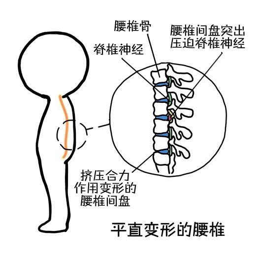 弯腰的姿势会破坏腰椎的生理曲度,让腰椎变直甚至反弓,从而对腰椎间盘