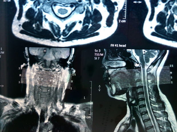 脊椎核磁共振检查结果 求帮忙看看
