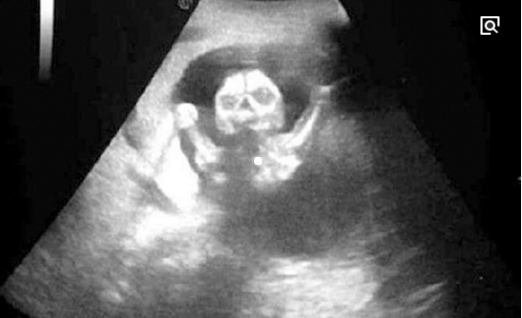 孕妇怀孕四个月,产检医生发现胎已死,查后,医生