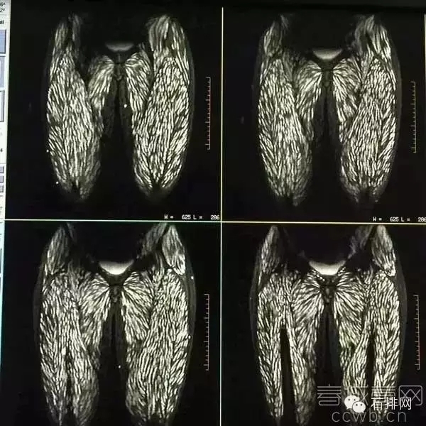 囊虫病怎样治疗康复?