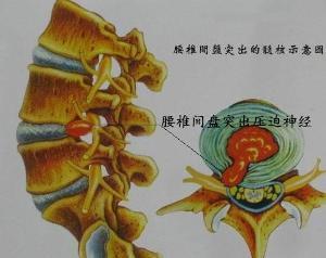腰椎间<em>盘</em>突出<em>要怎样</em>才会好_360问答