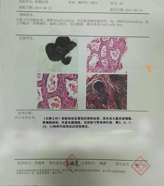 左肺尖磨玻璃结节影活检良性诊断结果