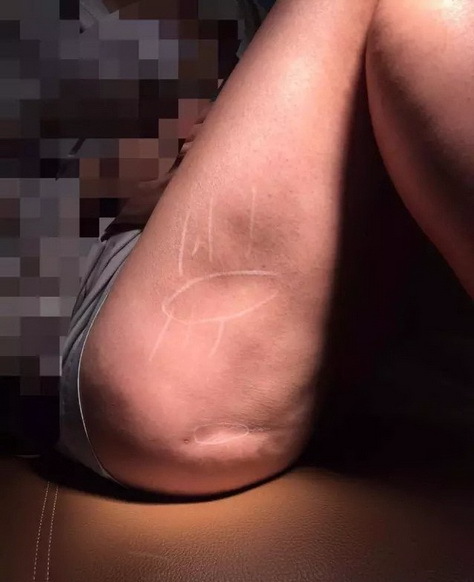 女子移大腿脂肪丰臀 一年后大腿凹凸不平