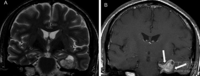 症状性癫痫常见 6 大病因的影像学表现