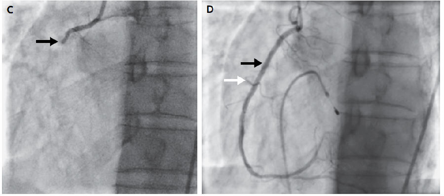 右室梗死的诊断和治疗,把握好这几个方面