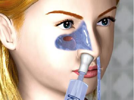 鼻炎最佳治疗方法