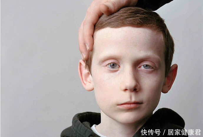 面瘫早期到底能不能针灸?急性期到底应该怎么