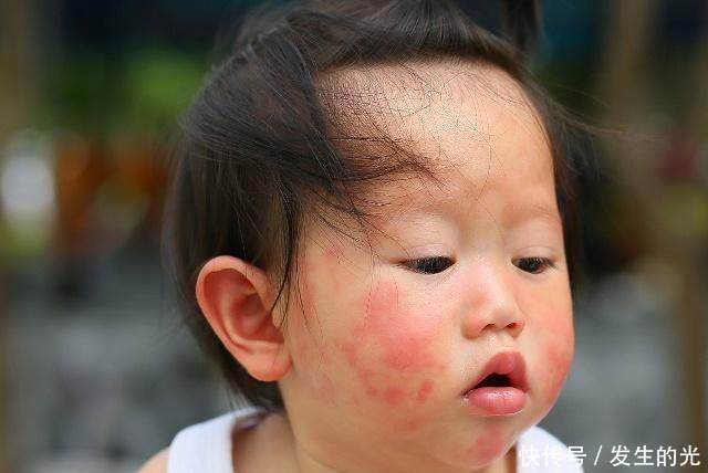 宝宝喝奶粉过敏,甚至吃个旺仔小馒头都起红疹