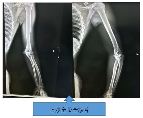 省内首台\"长骨拼接功能DR照相机\"在哈市一院投入使用