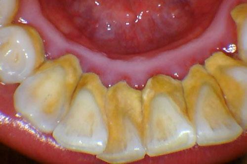 牙结石的危害到底有多大?