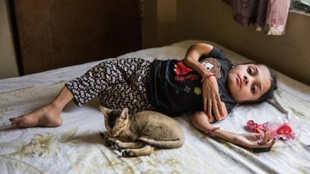 聊斋怪谈 印度女孩骨折1000次 长成了这样 不忍心看第二眼！