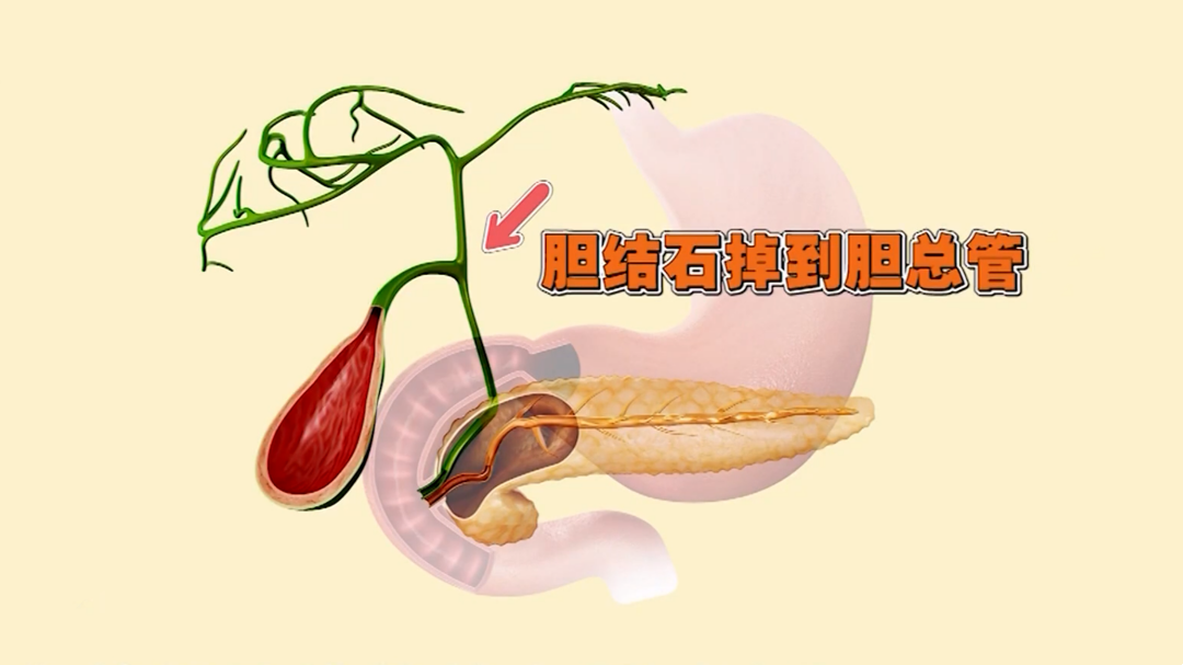 X诊所. 健康一“夏”特别策划 我是胆囊 有我没我重要吗？