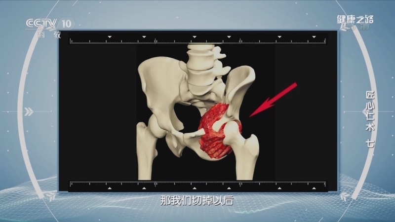 健康之路 《健康之路》 20220822 匠心仁术（七）