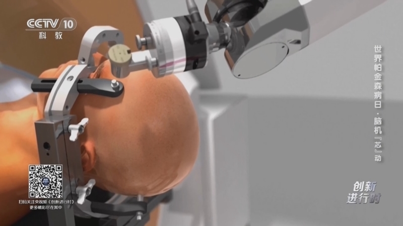 《创新进行时》 20260410 世界帕金森病日·脑机“芯”动