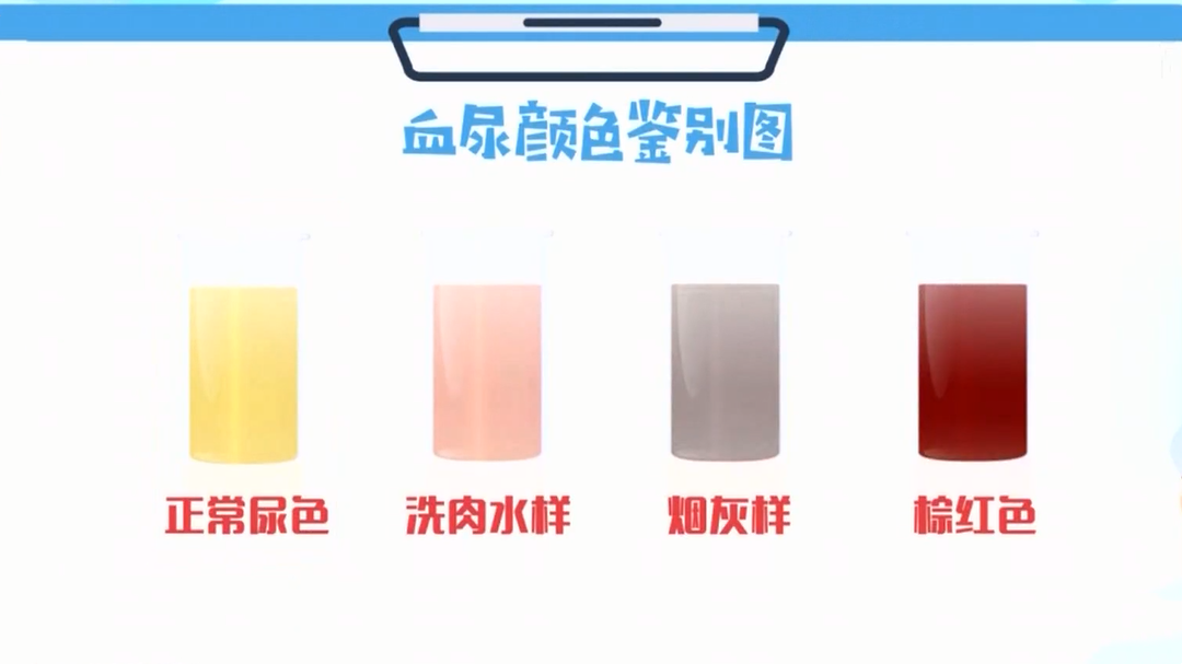 名医话养生 看得到红色的才是血尿吗？
