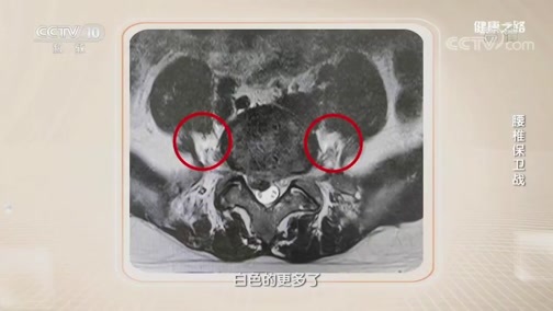 健康之路 《健康之路》 20191101 腰椎保卫战